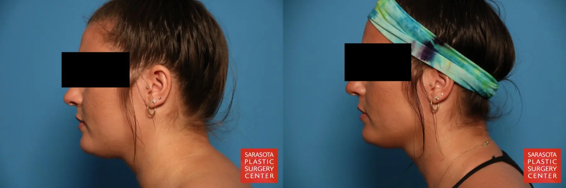 Facial Liposuction: Patient 5 - Before and After 3