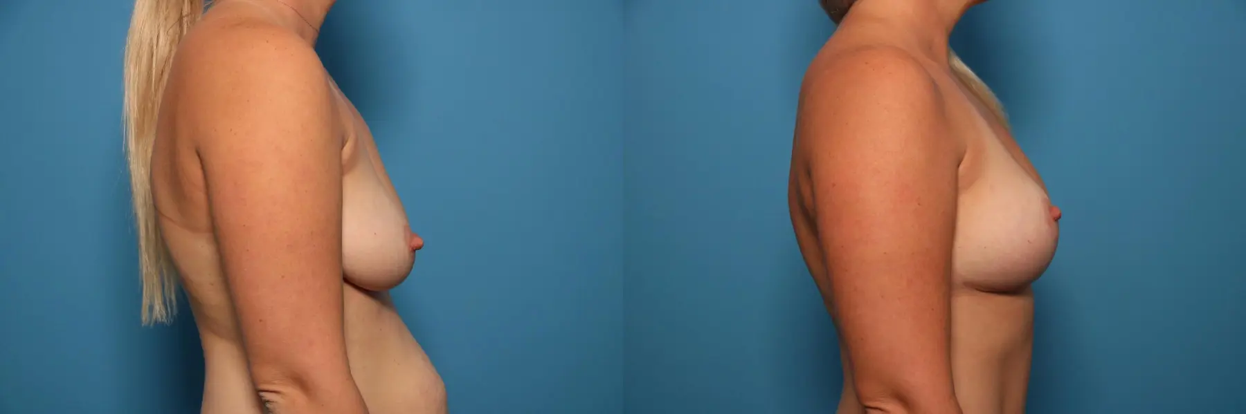 Fat Transfer - Breast: Patient 3 - Before and After 3