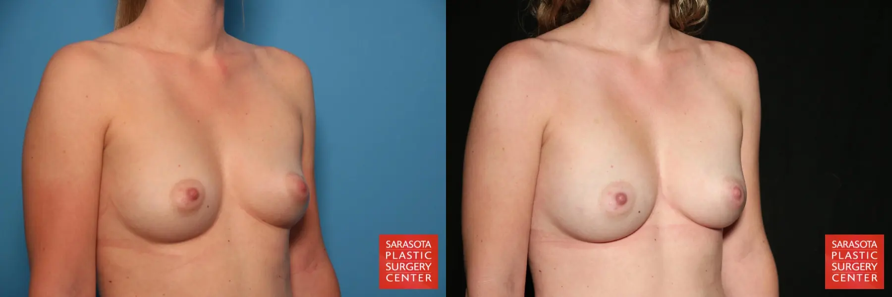 Fat Transfer - Breast: Patient 4 - Before and After 4