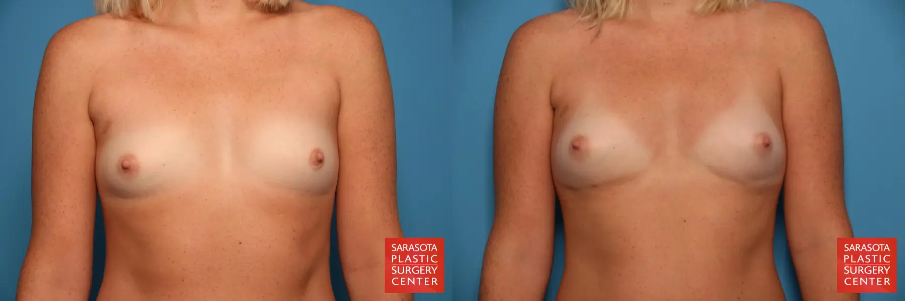 Fat Transfer - Breast: Patient 5 - Before and After  