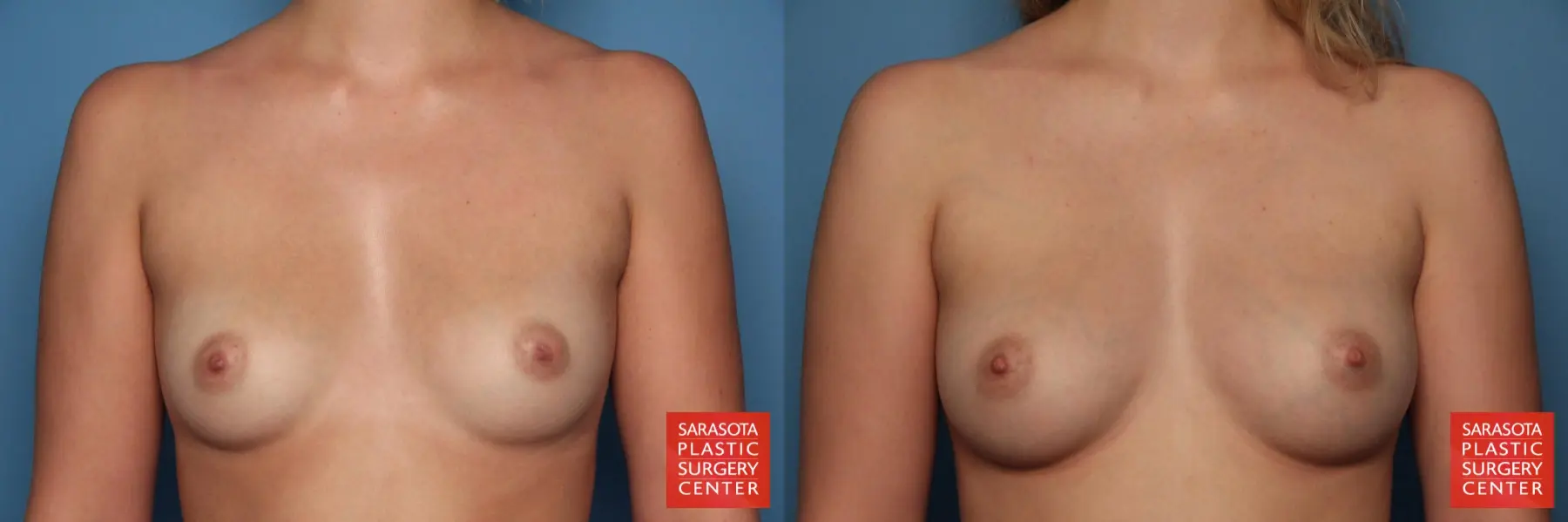 Fat Transfer - Breast: Patient 1 - Before and After  