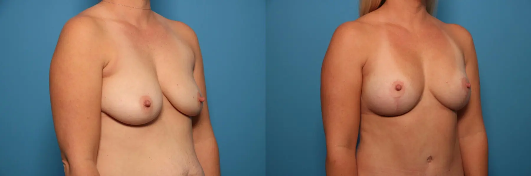 Fat Transfer - Breast: Patient 3 - Before and After 2