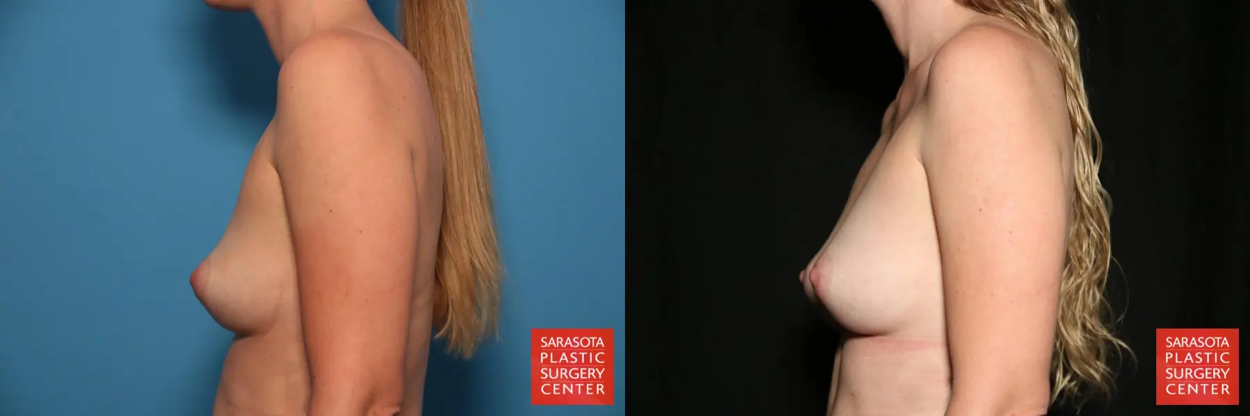 Fat Transfer - Breast: Patient 4 - Before and After 3