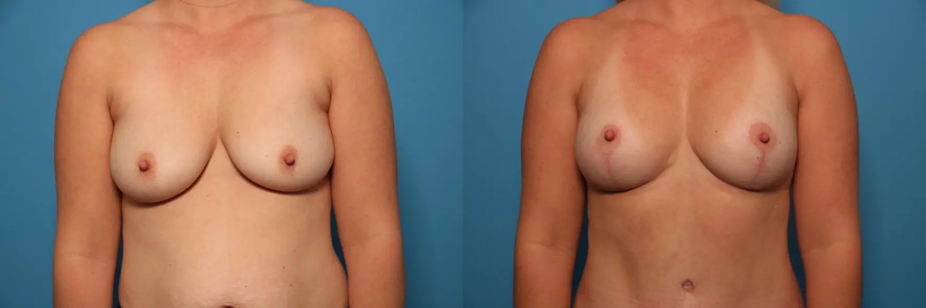 Fat Transfer - Breast: Patient 3 - Before and After  