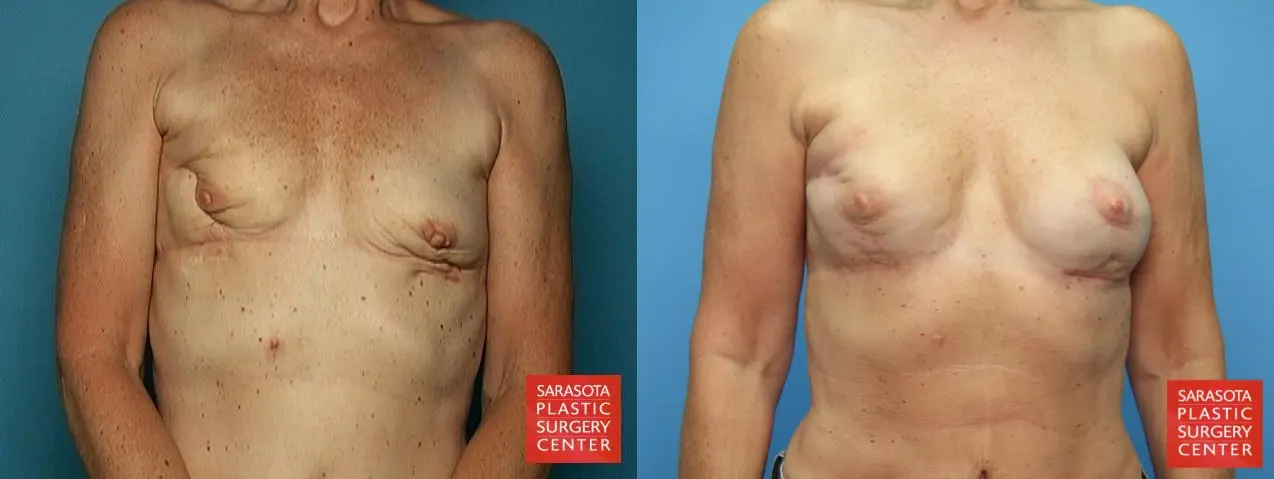 Fat Transfer - Breast: Patient 2 - Before and After  