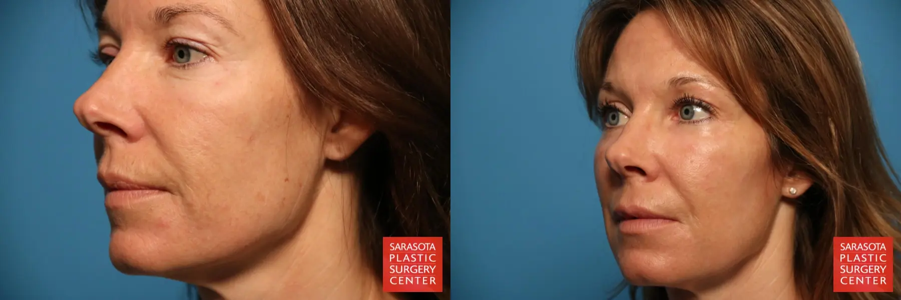 Fat Transfer - Face: Patient 17 - Before and After 2