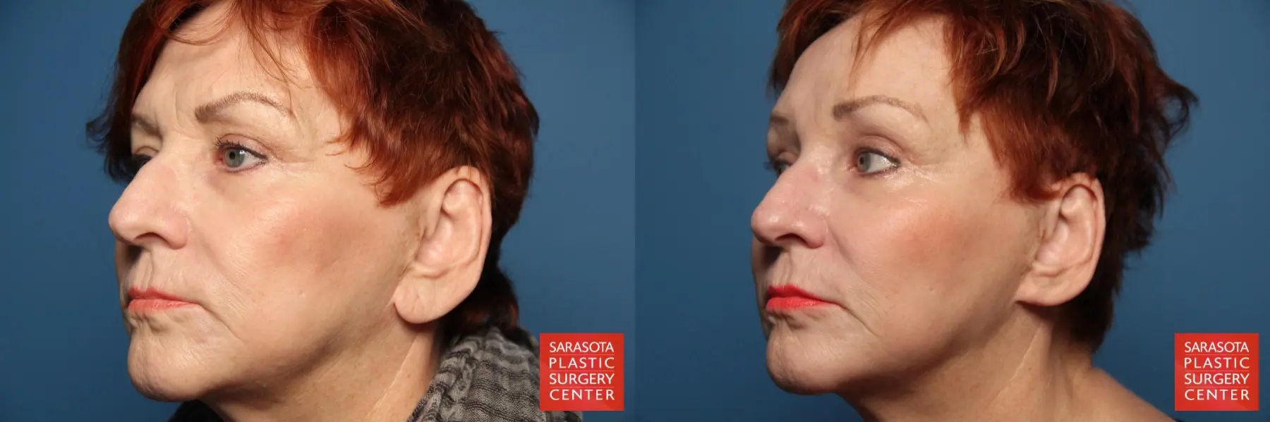 Fat Transfer - Face: Patient 13 - Before and After 2