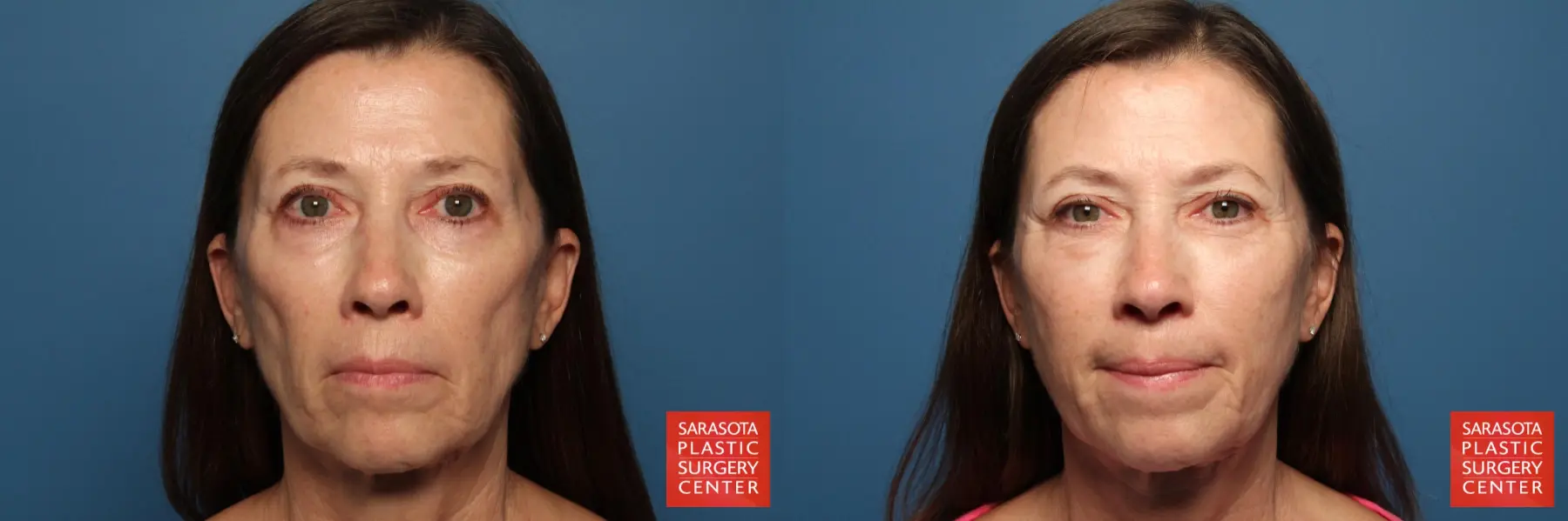 Fat Transfer - Face: Patient 12 - Before and After  