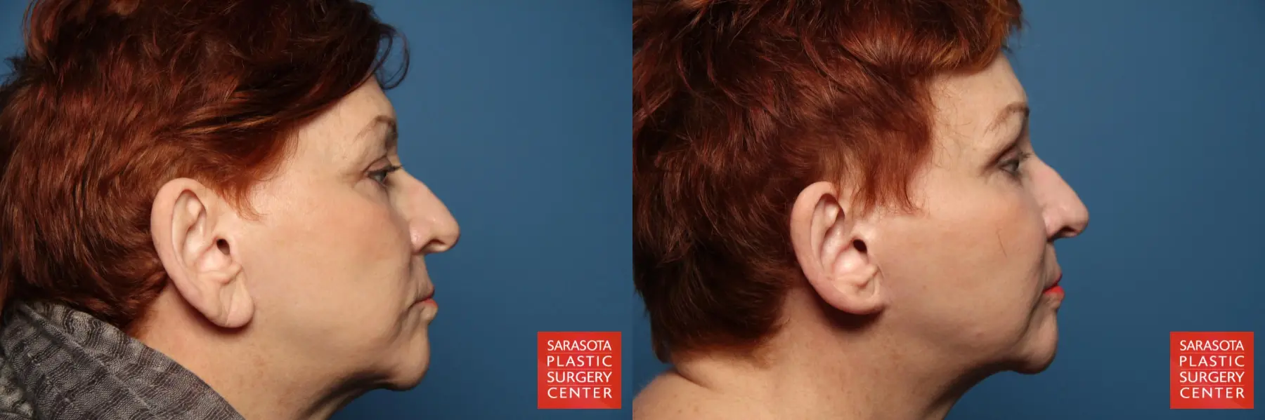 Fat Transfer - Face: Patient 13 - Before and After 5