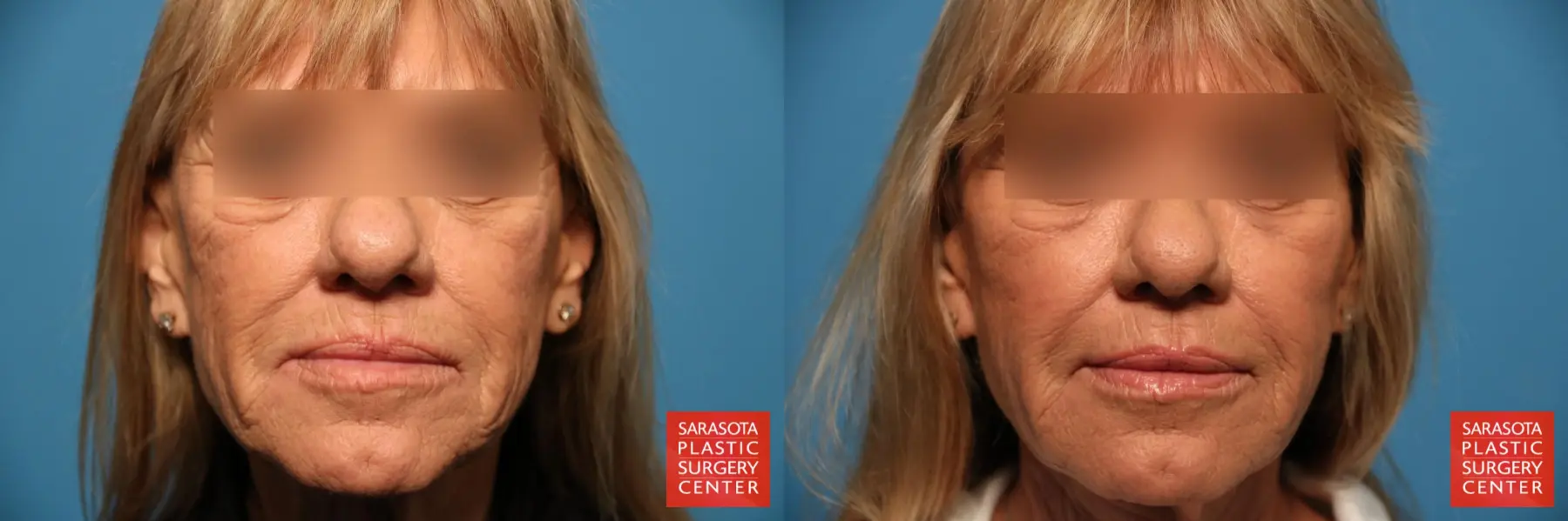 Fat Transfer - Face: Patient 21 - Before and After  