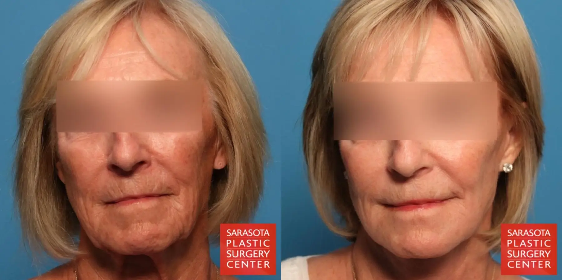 Fat Transfer - Face: Patient 14 - Before and After  