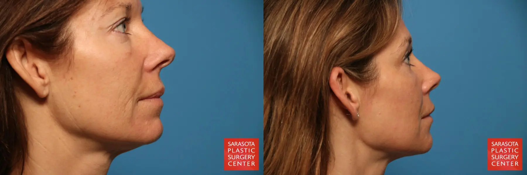 Fat Transfer - Face: Patient 17 - Before and After 5