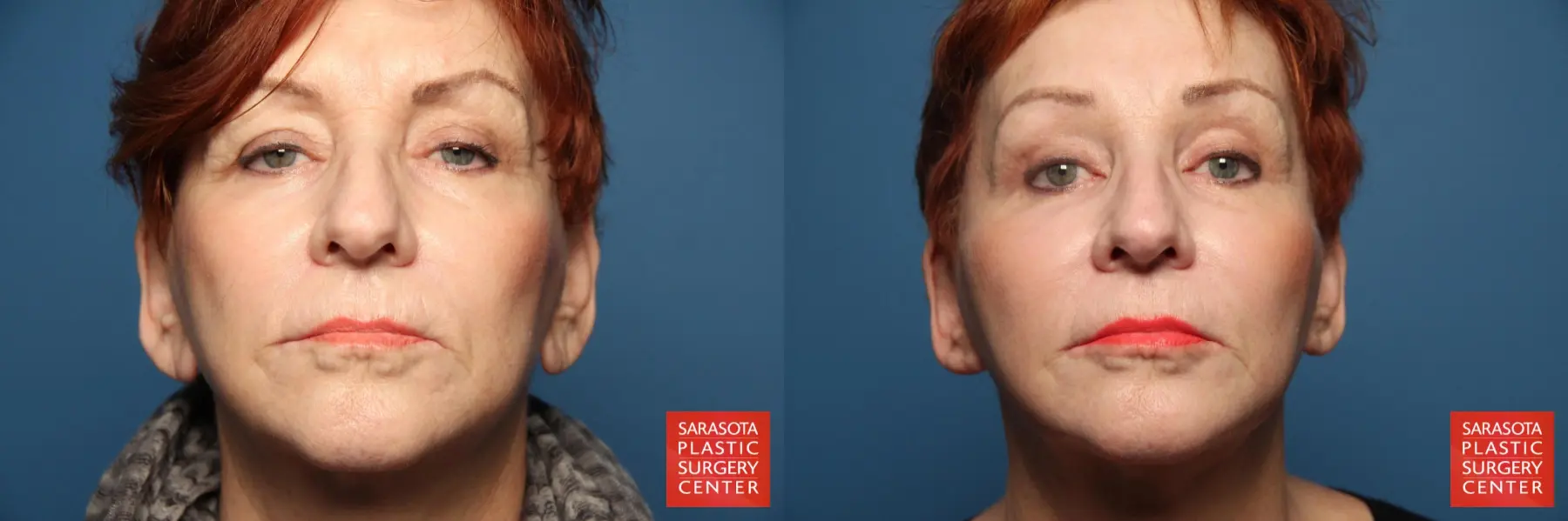 Fat Transfer - Face: Patient 13 - Before and After  
