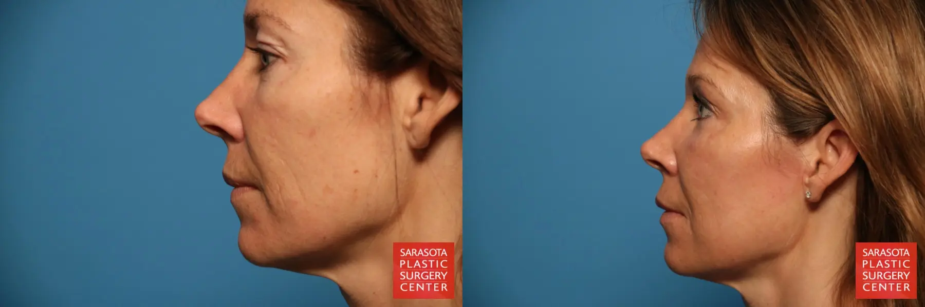 Fat Transfer - Face: Patient 17 - Before and After 3