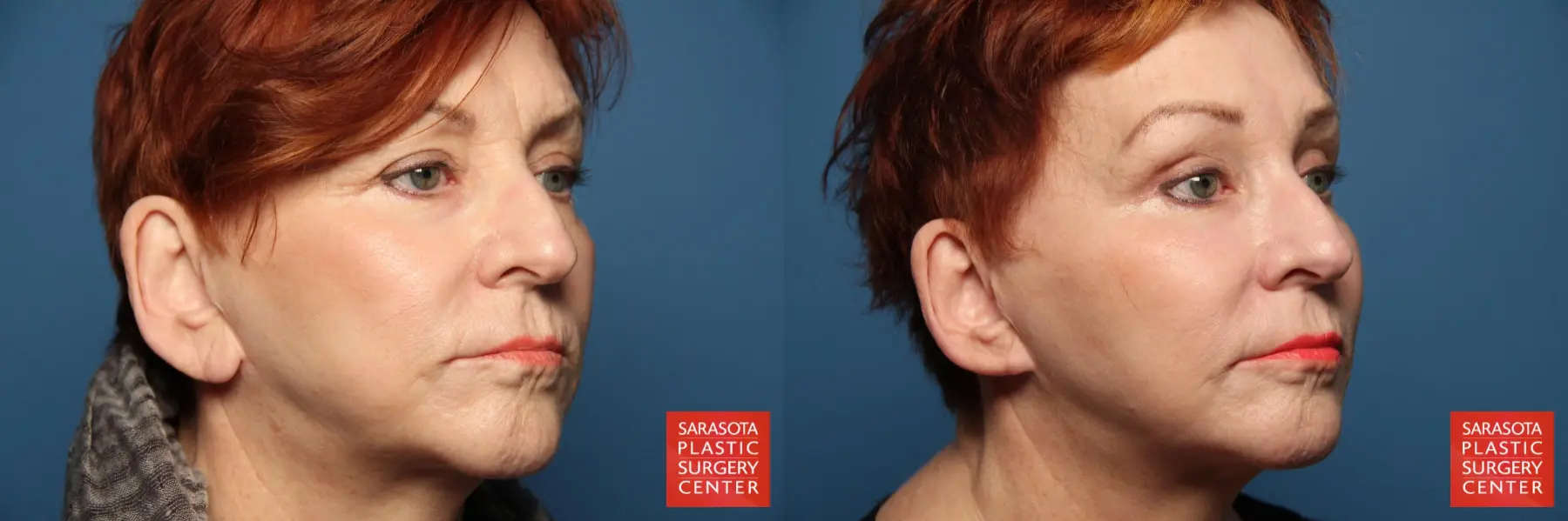 Fat Transfer - Face: Patient 13 - Before and After 4