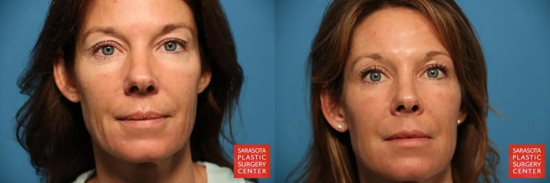 Fat Transfer - Face: Patient 17 - Before and After  