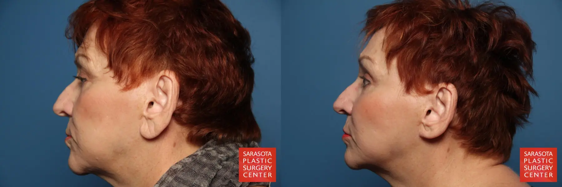 Fat Transfer - Face: Patient 13 - Before and After 3