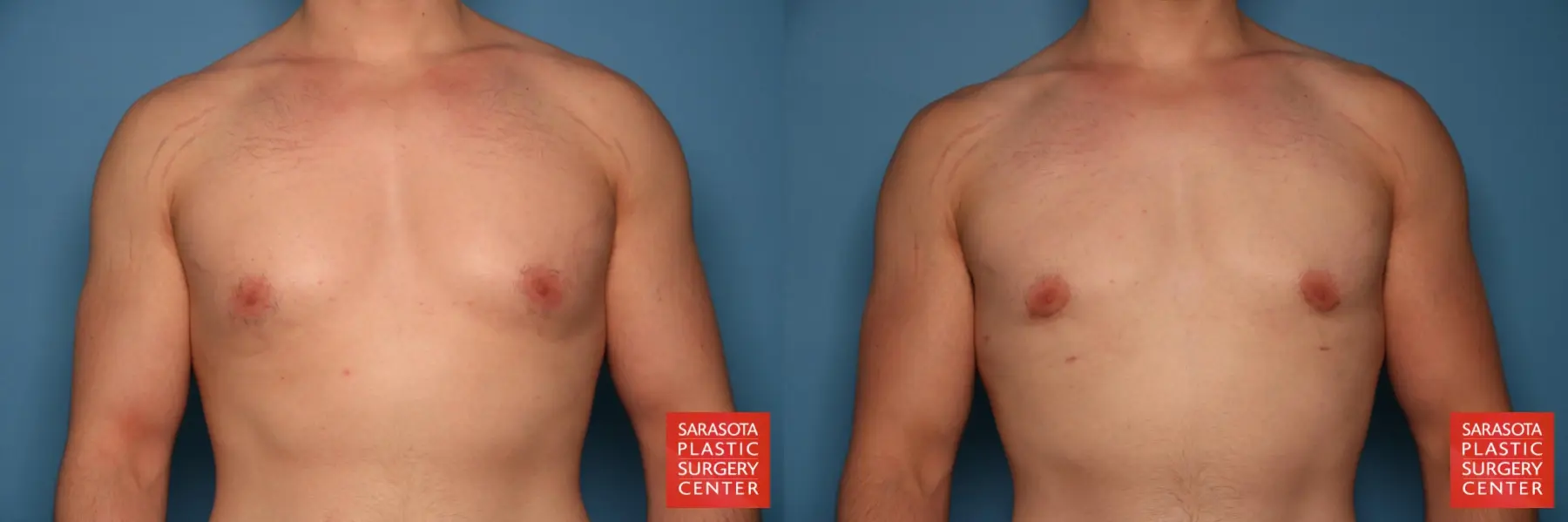 Gynecomastia: Patient 21 - Before and After  