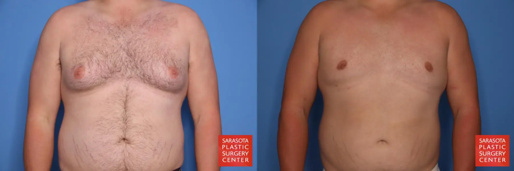 Gynecomastia: Patient 7 - Before and After  