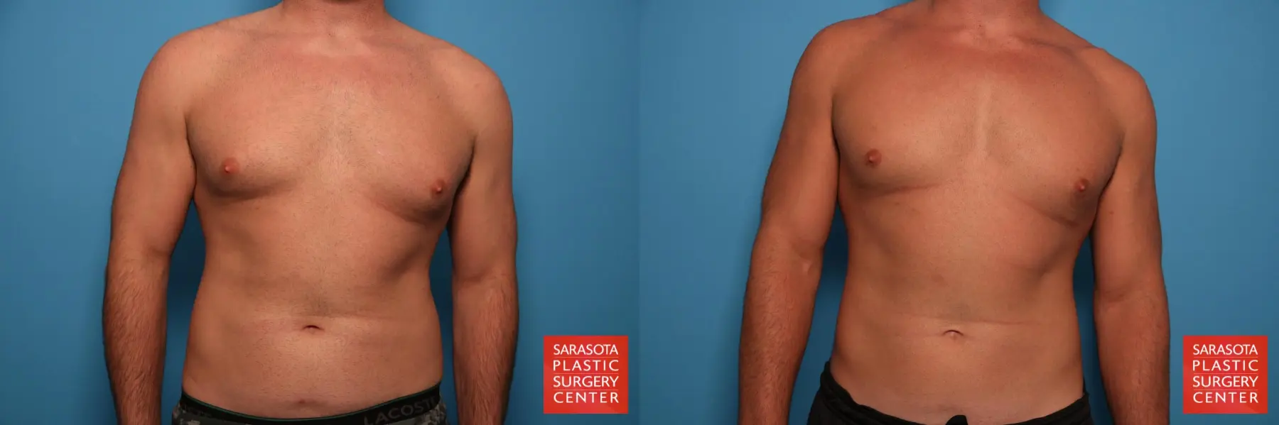 Gynecomastia: Patient 1 - Before and After 1