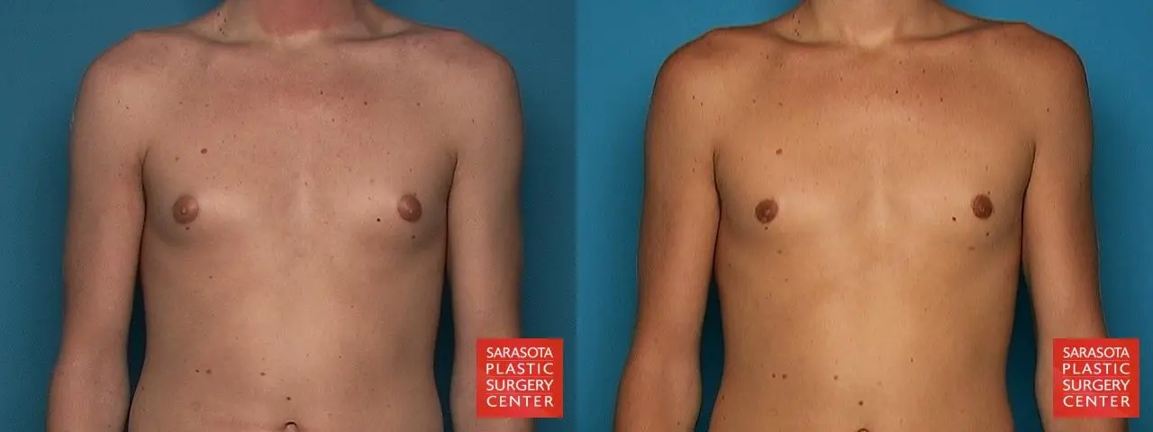 Gynecomastia: Patient 2 - Before and After 1