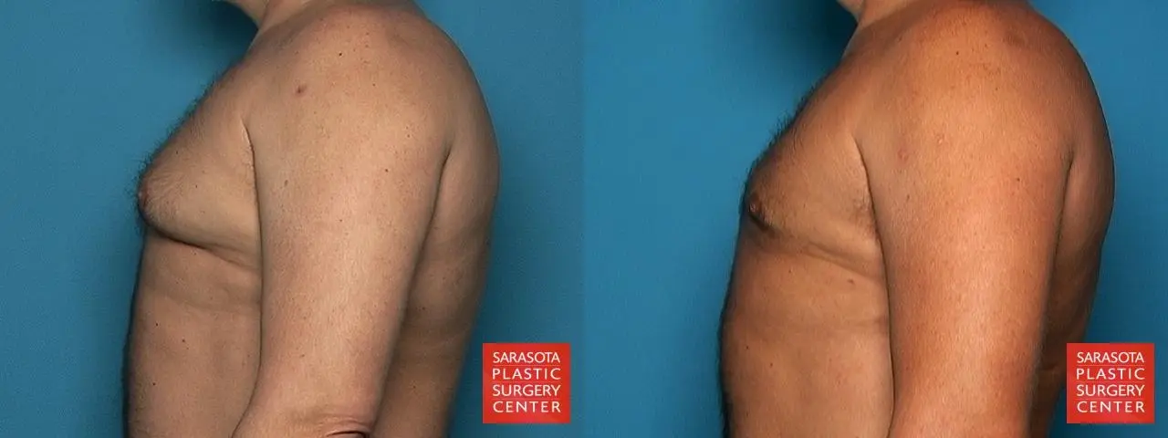 Gynecomastia: Patient 10 - Before and After 3