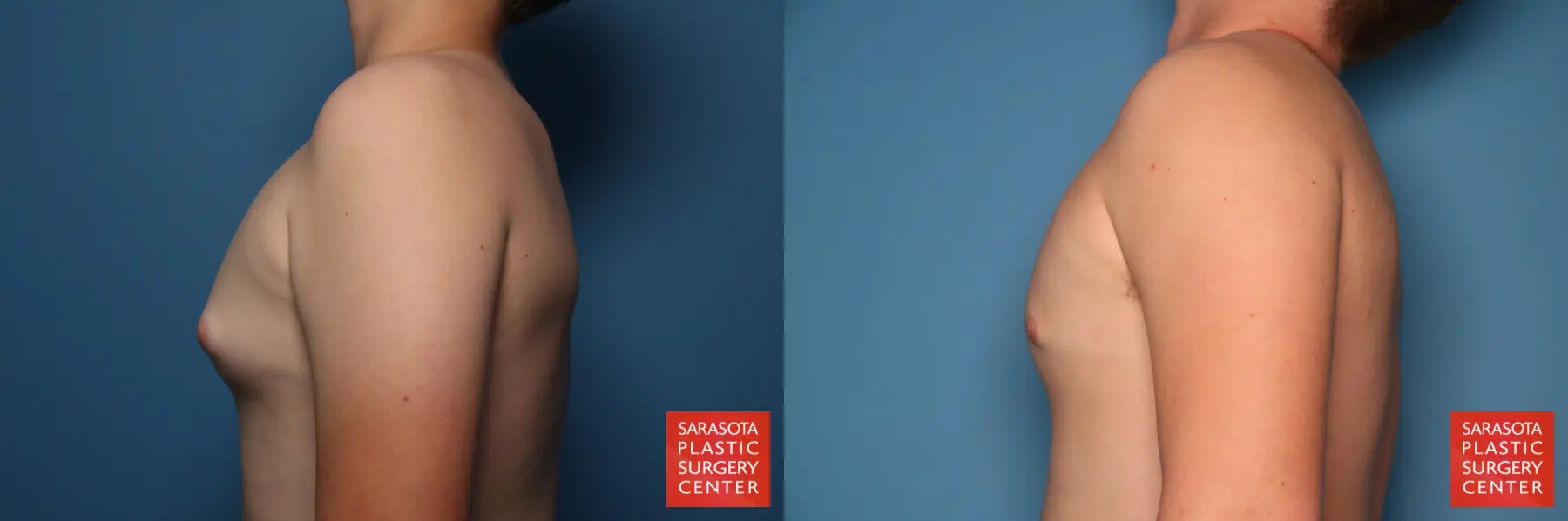 Gynecomastia: Patient 4 - Before and After 3