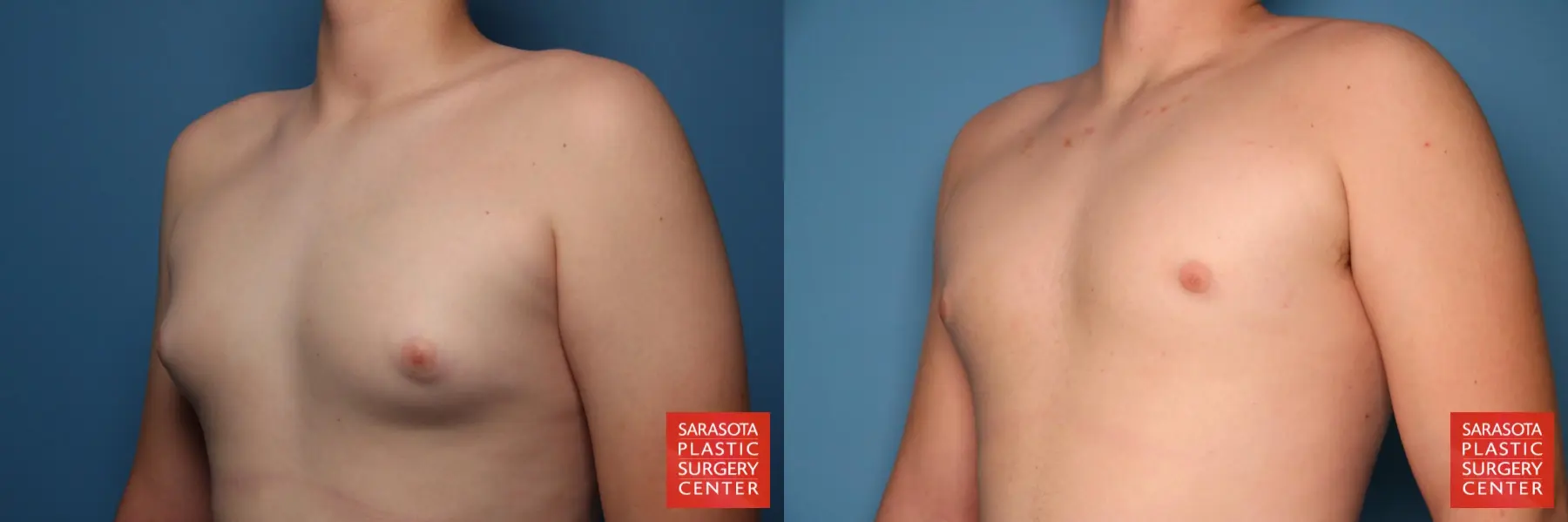 Gynecomastia: Patient 4 - Before and After 2