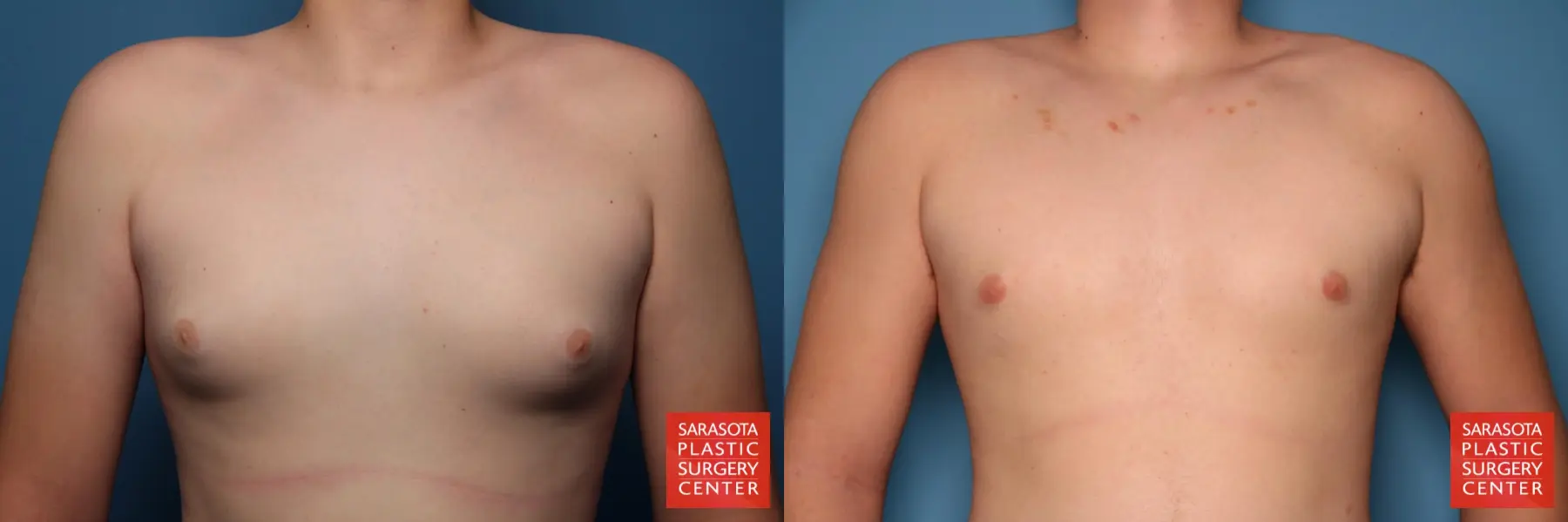 Gynecomastia: Patient 4 - Before and After 1