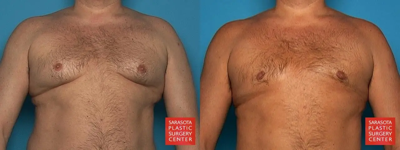 Gynecomastia: Patient 10 - Before and After  