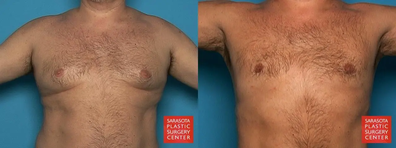 Gynecomastia: Patient 10 - Before and After 4