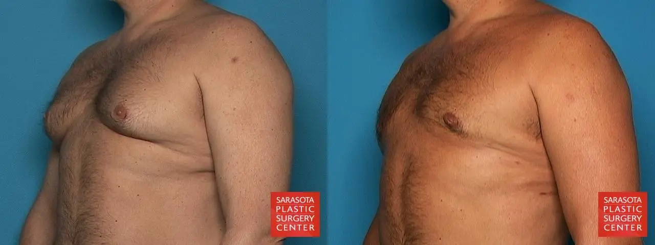 Gynecomastia: Patient 10 - Before and After 2