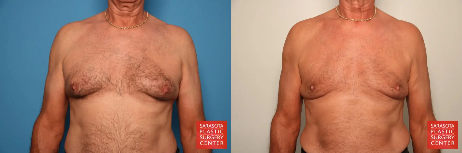 Gynecomastia: Patient 13 - Before and After  