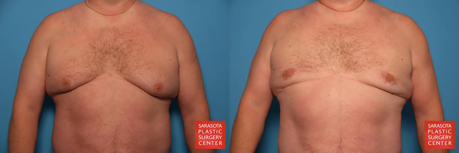 Gynecomastia: Patient 12 - Before and After  