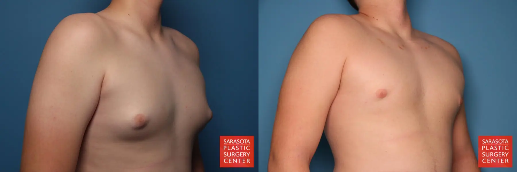 Gynecomastia: Patient 4 - Before and After 4