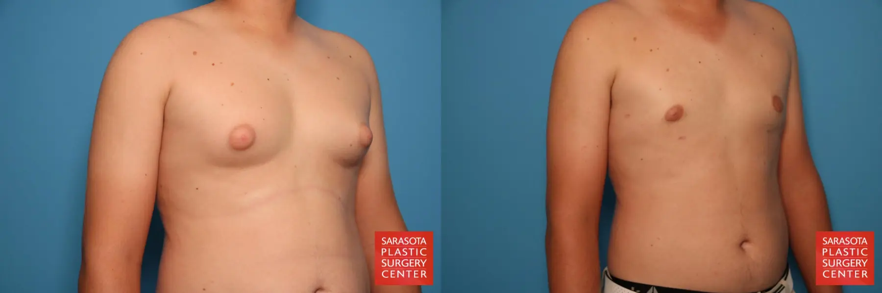 Gynecomastia: Patient 8 - Before and After 3
