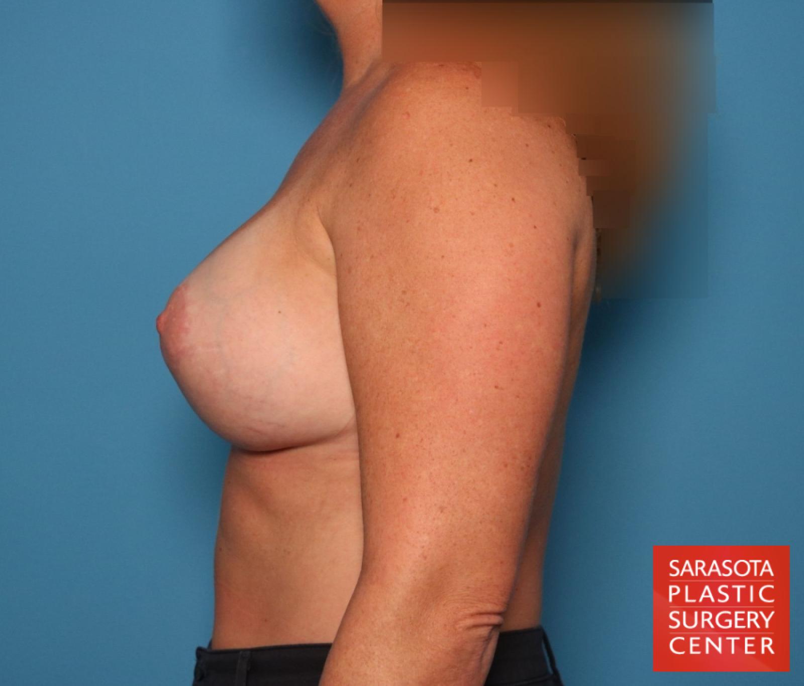 Breast Augmentation With Lift: Patient 80 - After 3