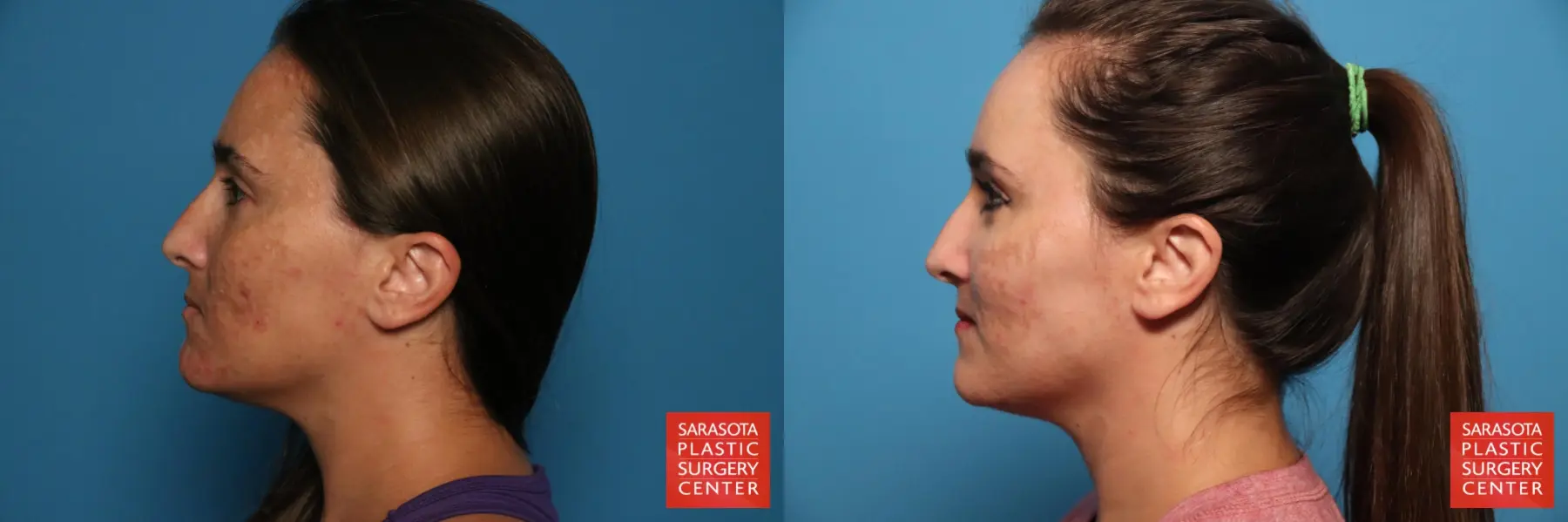 Laser Skin Resurfacing - Face: Patient 34 - Before and After 3