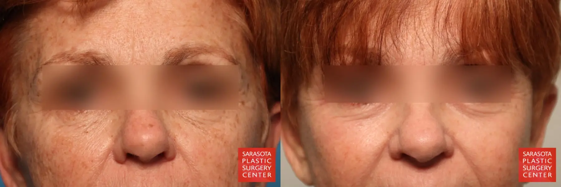 Laser Skin Resurfacing - Face: Patient 2 - Before and After  