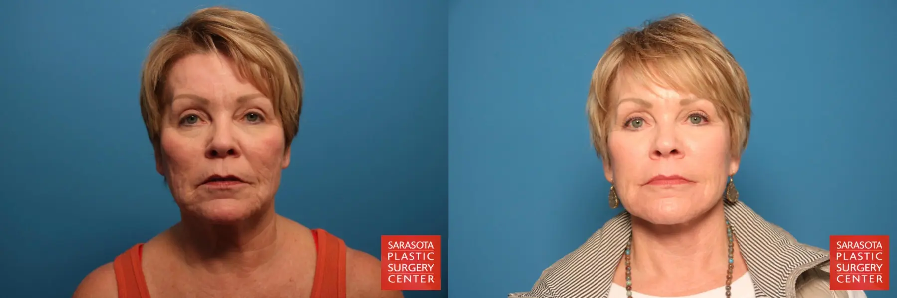 Laser Skin Resurfacing - Face: Patient 29 - Before and After  