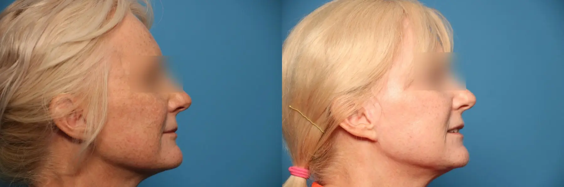 Laser Skin Resurfacing - Face: Patient 6 - Before and After 5