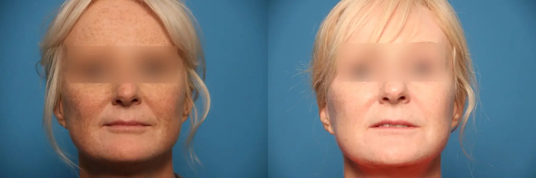 Laser Skin Resurfacing - Face: Patient 6 - Before and After  