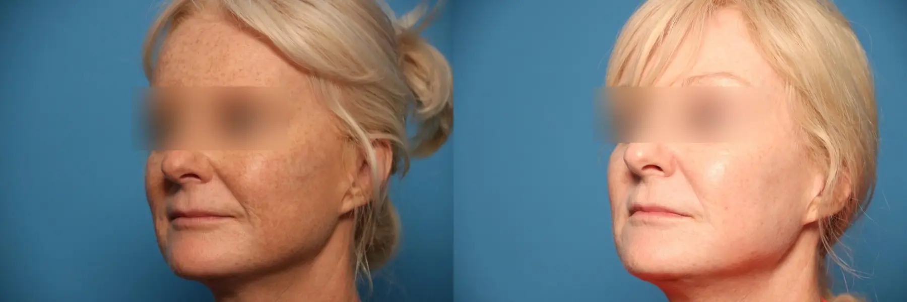 Laser Skin Resurfacing - Face: Patient 6 - Before and After 2