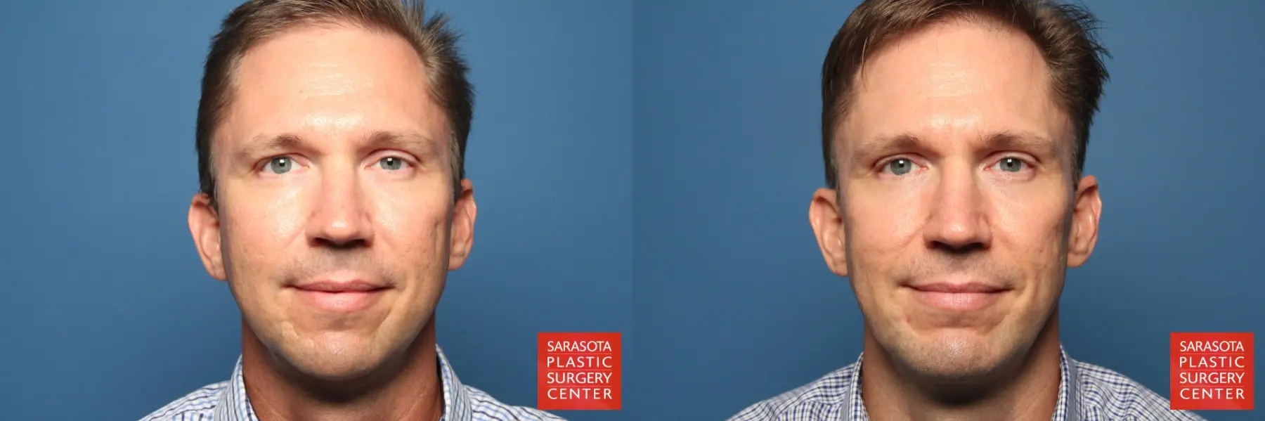 Laser Skin Resurfacing - Face: Patient 7 - Before and After  