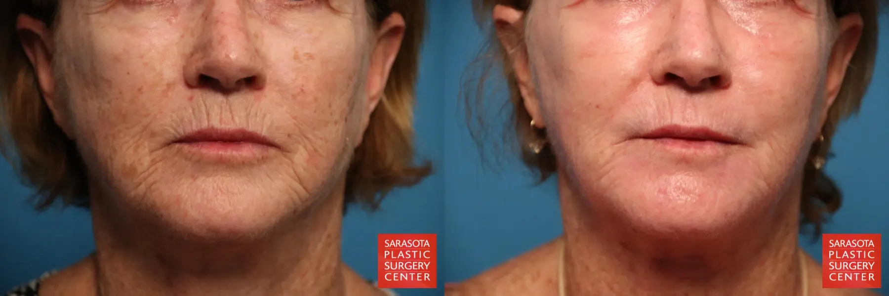 Laser Skin Resurfacing - Face: Patient 16 - Before and After 6