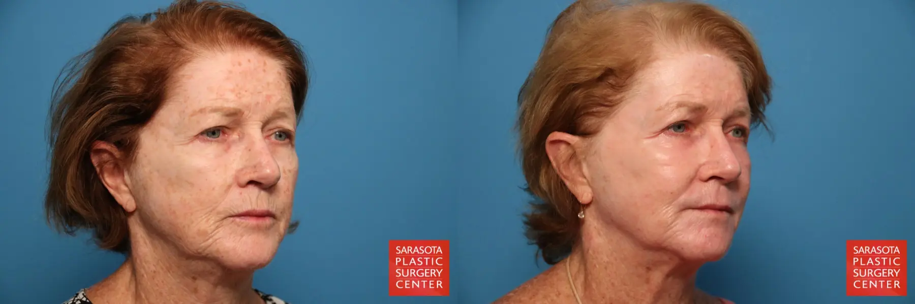 Laser Skin Resurfacing - Face: Patient 16 - Before and After 4