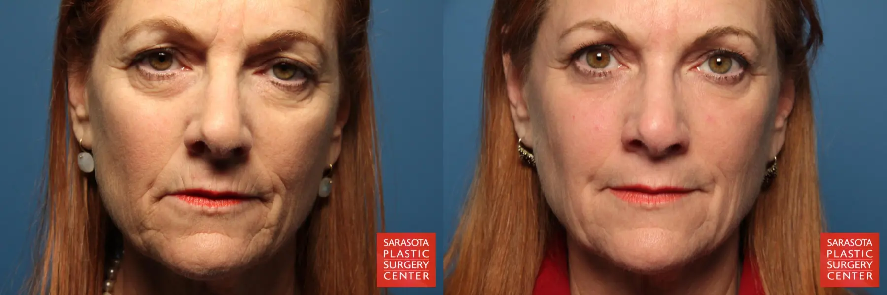 Laser Skin Resurfacing - Face: Patient 21 - Before and After  