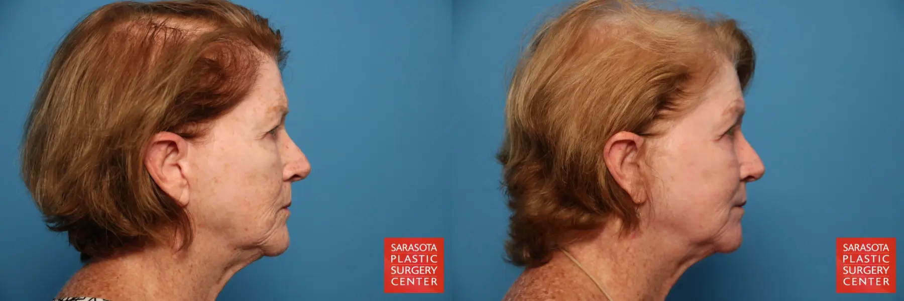 Laser Skin Resurfacing - Face: Patient 16 - Before and After 5