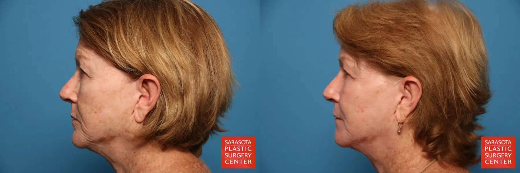 Laser Skin Resurfacing - Face: Patient 16 - Before and After 3