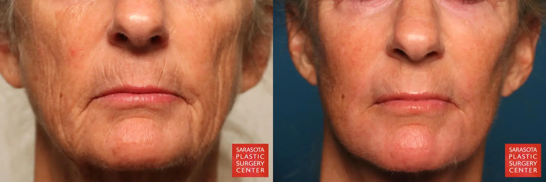 Laser Skin Resurfacing - Face: Patient 30 - Before and After  
